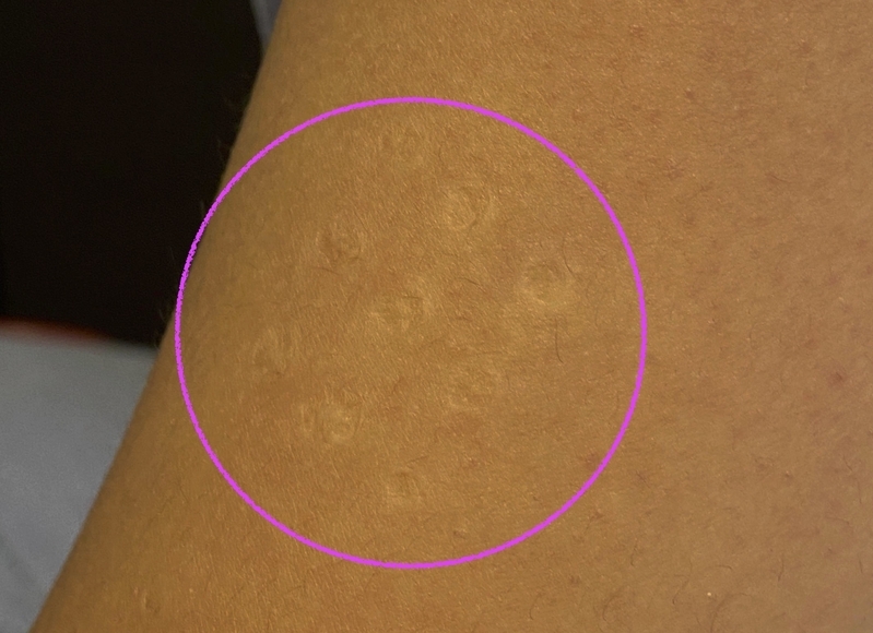 BCGワクチン接種の痕（筆者の長男の左上腕）