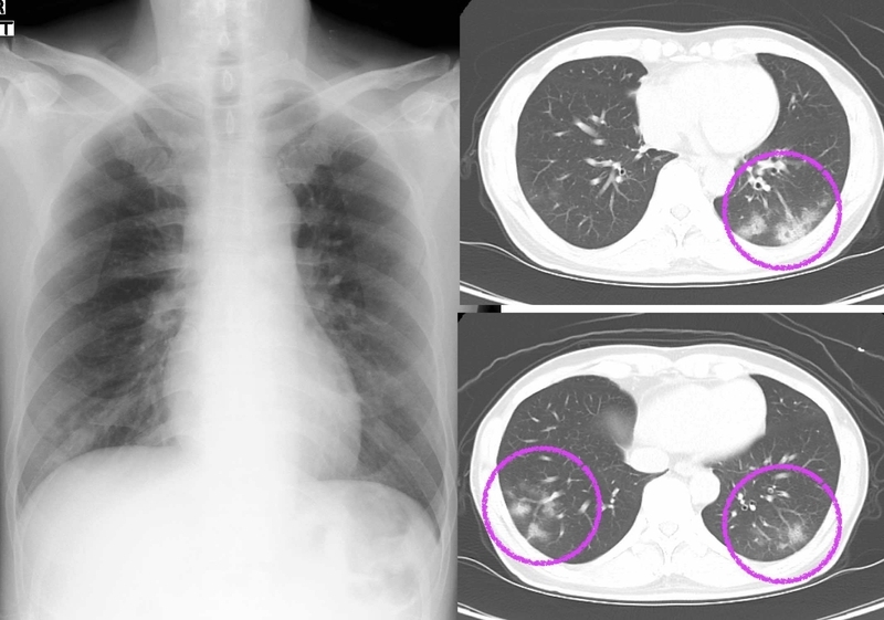 新型コロナウイルス感染症患者の胸部レントゲン（左）と胸部CT（右）（患者さんの許可を得て掲載しています）