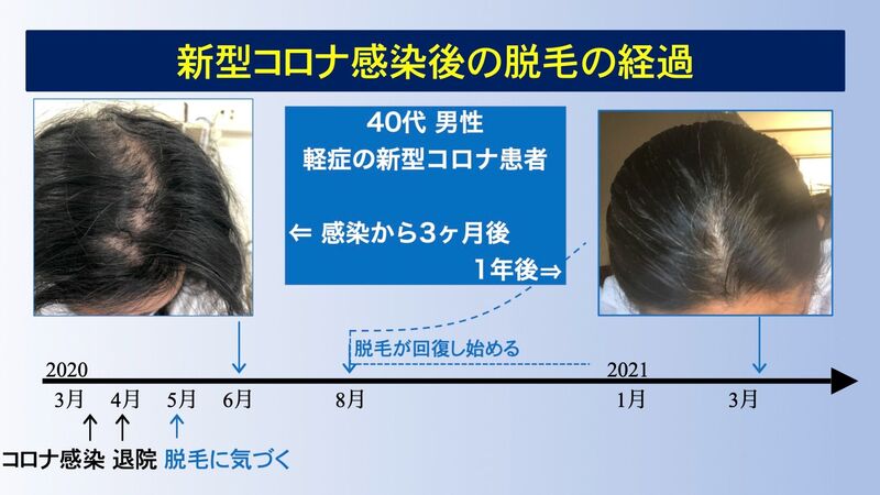 新型コロナ後遺症 脱毛の頻度とその経過について 忽那賢志 個人 Yahoo ニュース 新型コロナ後遺症 脱毛の頻度とその経過について 忽那賢志 個人 Yahoo ニュース