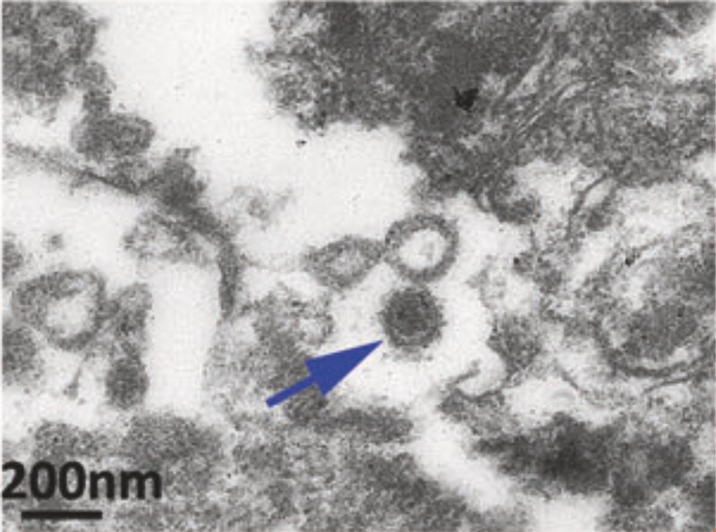 新型コロナで死亡した患者の精巣の電子顕微鏡写真。矢印は新型コロナウイルス（Cellular & Molecular Immunology volume 18, pages487–489 (2021)）