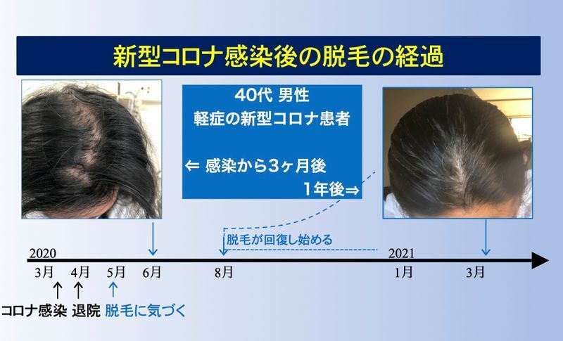 新型コロナ感染後の脱毛の経過(https://doi.org/10.1016/j.ijid.2021.04.088)