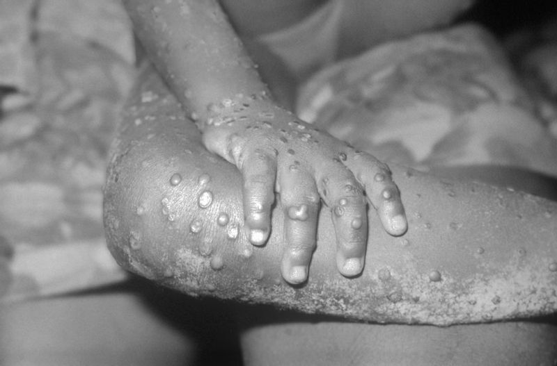 サル痘患者でみられた水疱(CDC PHILより)