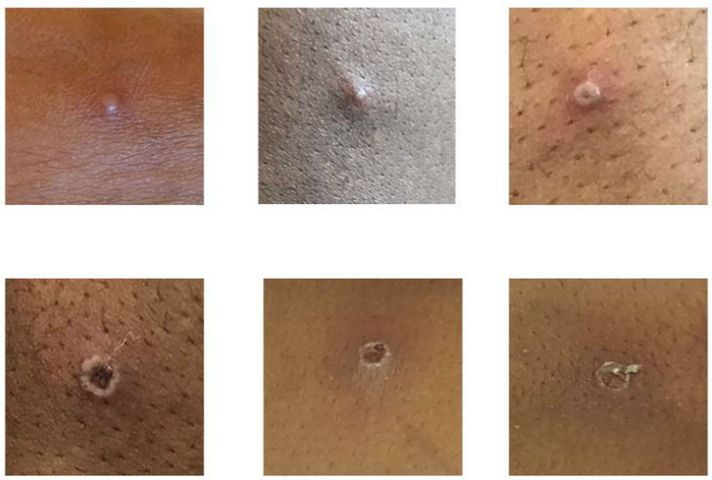 サル痘患者でみられる様々な水疱(UK Health Security Agencyより)