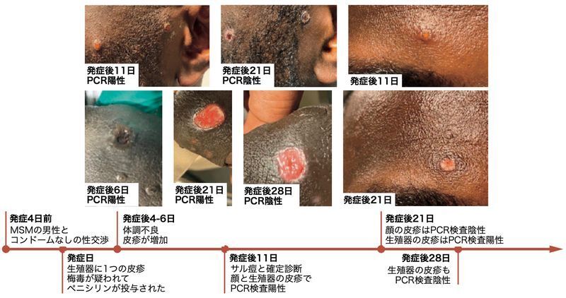 サル痘患者の皮疹の経過(DOI: 10.1056/NEJMoa2207323より)