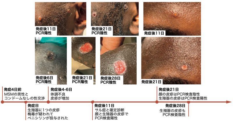 サル痘患者の皮疹の経過（DOI: 10.1056/NEJMoa2207323より）