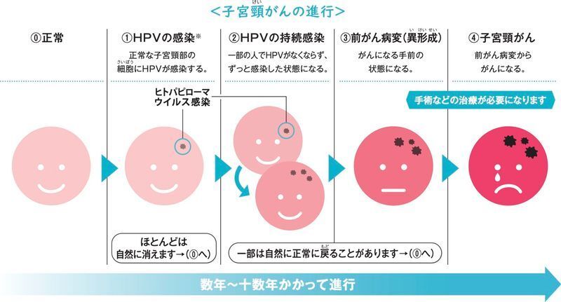 子宮頸がんの進行（厚生労働省「ヒトパピローマウイルス感染症とは」より）