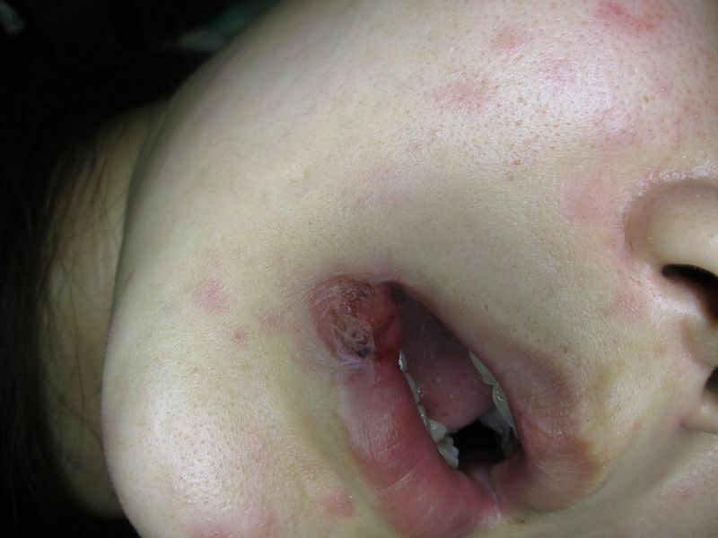 口唇に出現した一期梅毒による潰瘍病変（患者さんの同意を得た上で筆者撮影.、掲載）