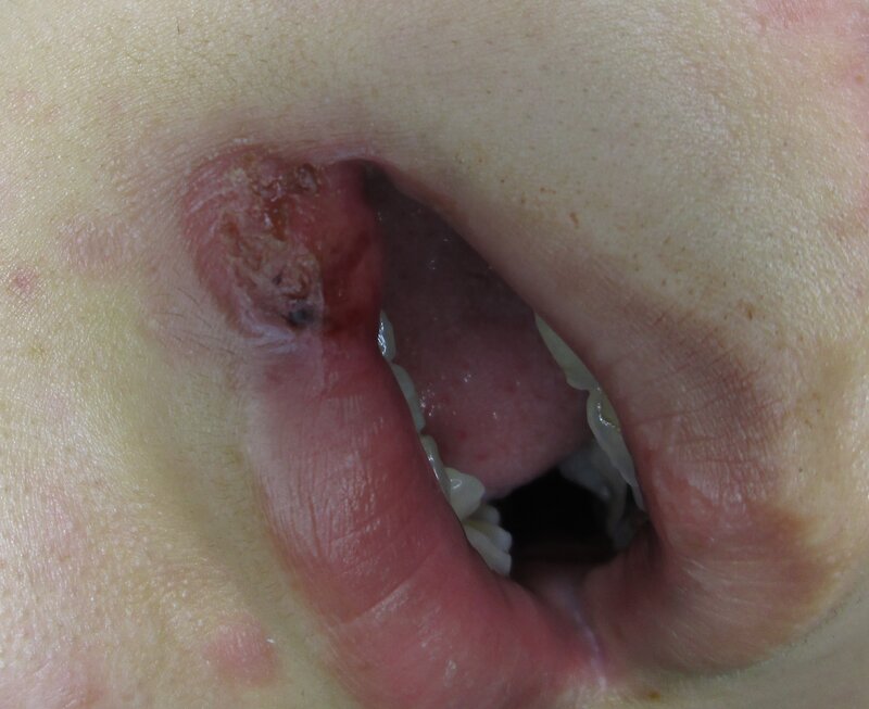 口唇に出現した一期梅毒による潰瘍病変（患者さんの同意を得た上で筆者撮影.、掲載）