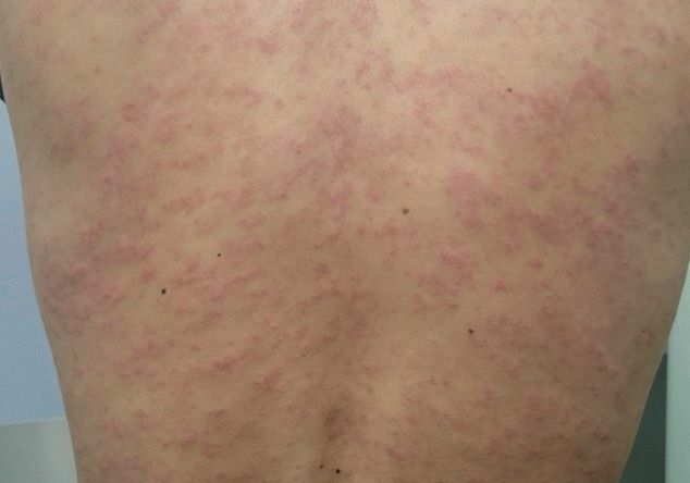 旋毛虫症の患者で見られた皮疹（Emerg Infect Dis. 2018 Aug;24(8):1532-1535. ）