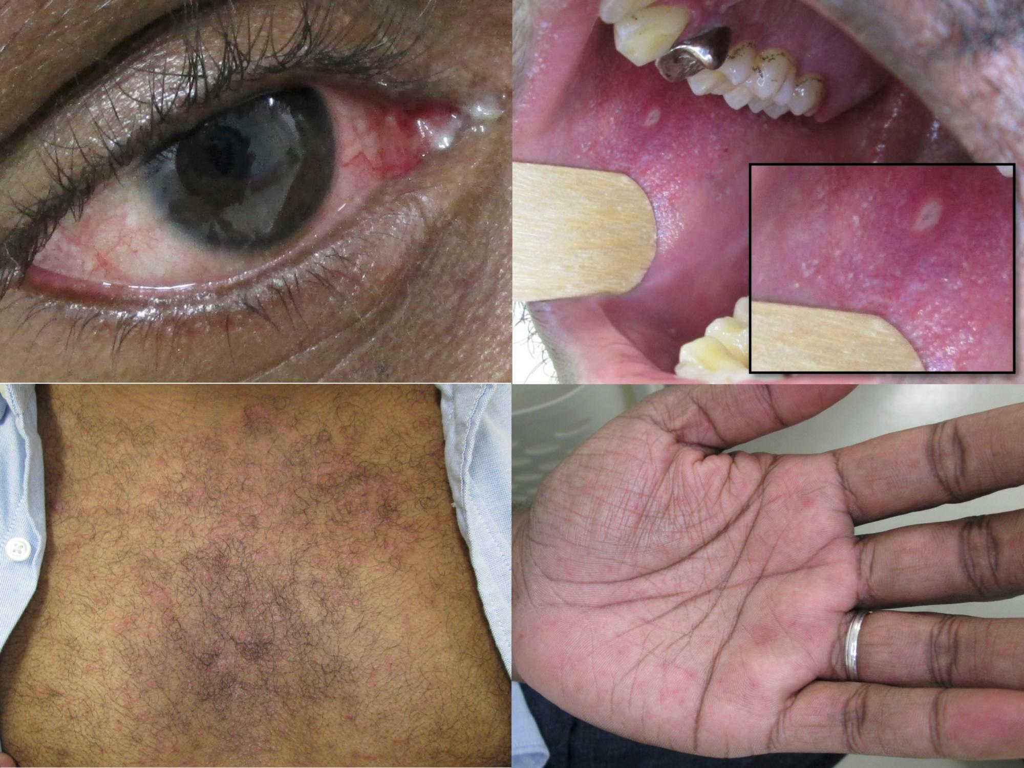 麻しん患者の眼球結膜充血、眼視（左上）、コプリック斑（右上）、体幹および手のひらの皮疹（左下、右下）患者さんの同意を得た上で筆者撮影