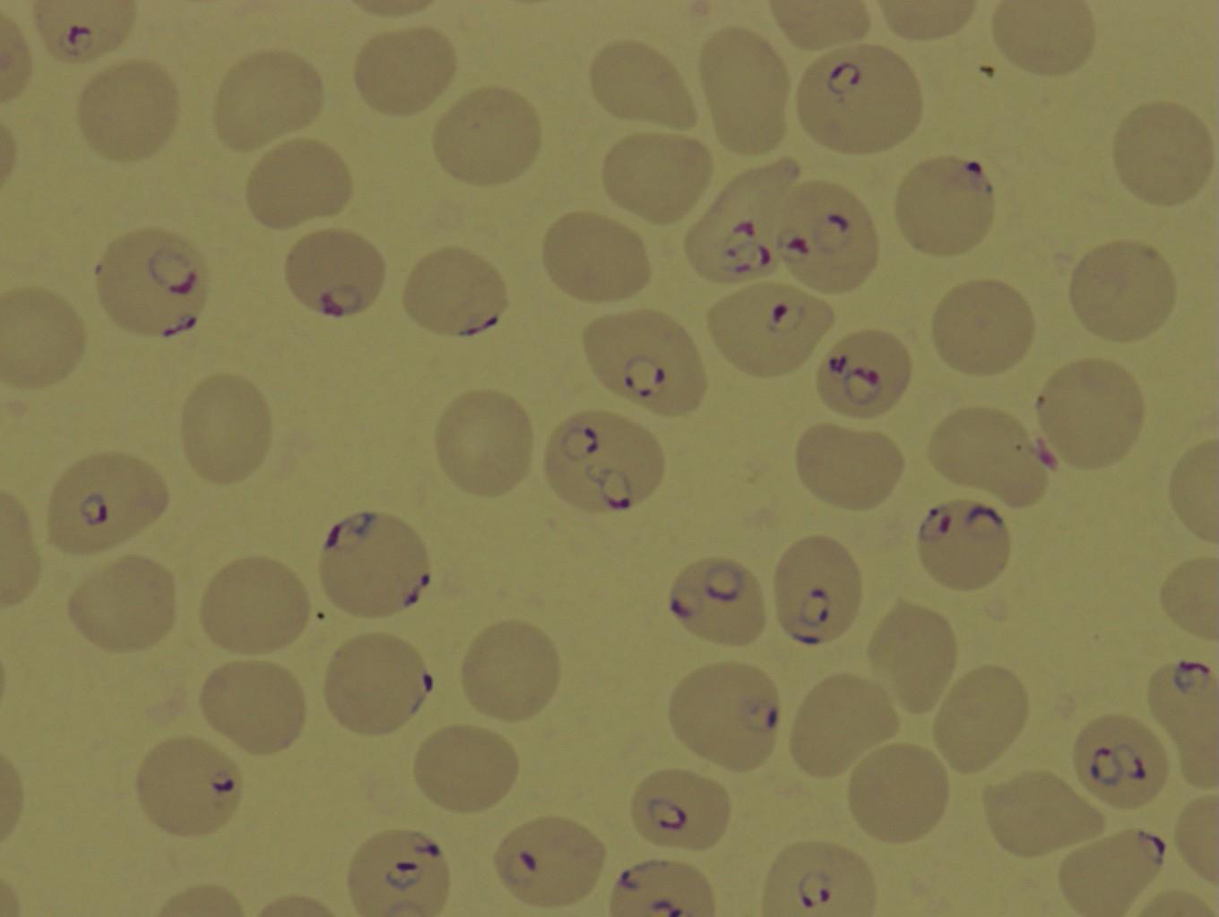 末梢血のギムザ染色で観察された熱帯熱マラリア原虫（筆者撮影）