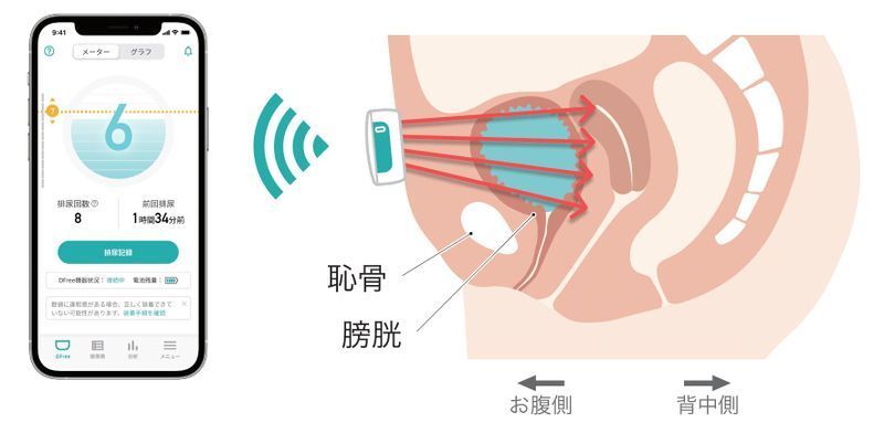 膀胱の溜まり具合を、連動したスマホなどを通じて伝える