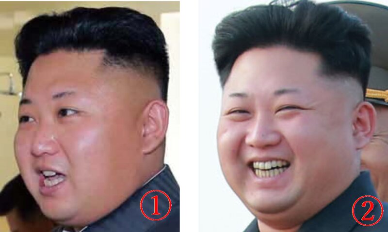 2014年の写真。１は手術前、２は手術後（朝鮮中央通信よりキャプチャー）