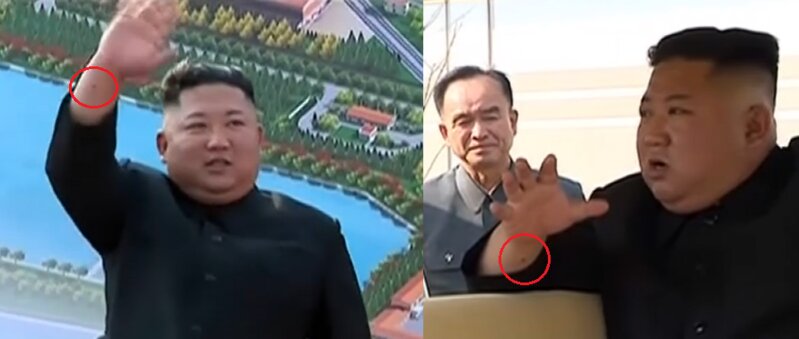 金委員長の右手首に薄黒いものが確認できる（朝鮮中央テレビよりキャプチャー。赤丸は筆者）