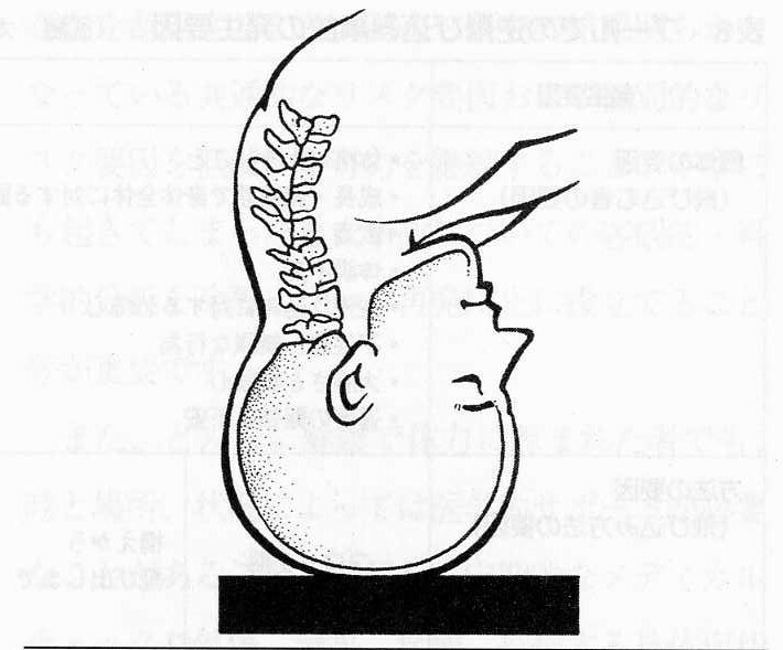 プール底に頭部が激突し、頸髄・頸椎を損傷（武藤芳照、1982『水泳の医学』ブックハウスHD）