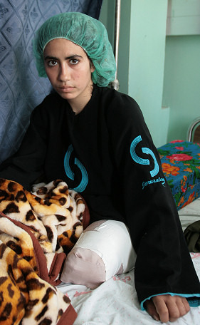国連の避難所で攻撃を受け、片足を失った女性