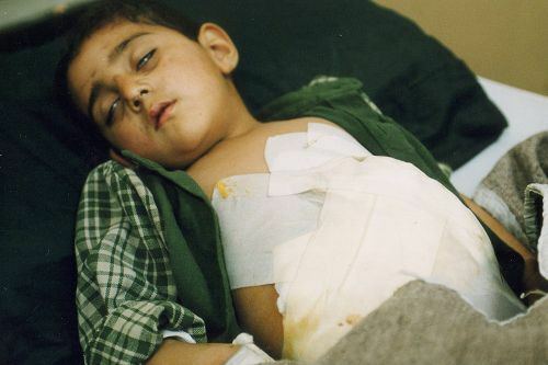 米軍の爆撃で負傷したイラクの子ども