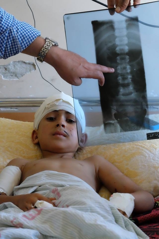 イスラエルのドローンに攻撃されたガザの少年。2014年夏、筆者撮影