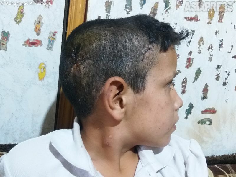 アハマドさんの9歳の息子は頭蓋骨を損傷。一命はとりとめたが、後頭部にはいまも傷が残る。（2021年12月、シリア・イドリブ・撮影：ムハンマド・アル・アスマール）