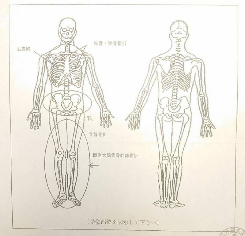 死亡診断書に記載された受傷部位。CT検査の結果、小柳さんは首から下の主要な骨がほとんど骨折していたことがわかった（遺族提供）