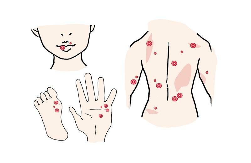 梅毒に特徴的な症状。手、下肢、前腕、背などを中心に痛みをともなわない紅斑が現れる。